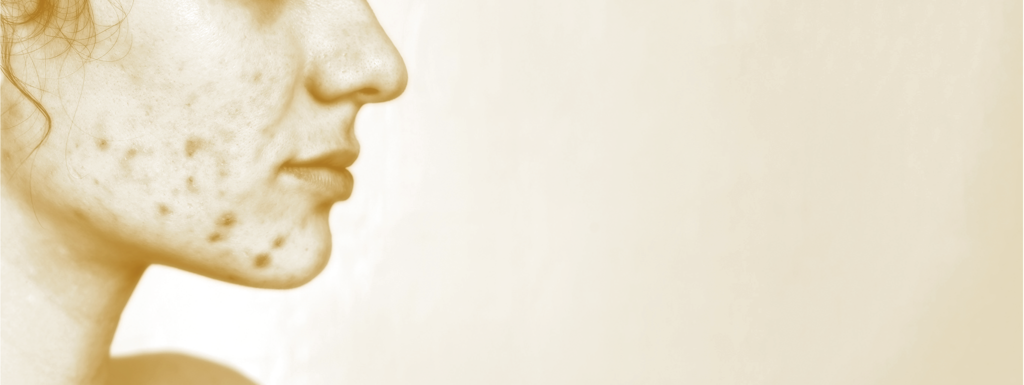 Acne, oxidatieve stress en metabole ontregeling