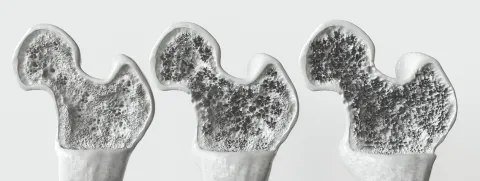 Zwakke botten vs dementie
