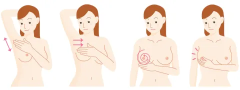 Jodium en borstkankerkans