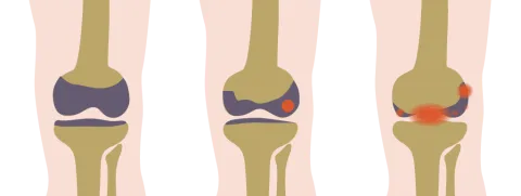 Leefstijlinterventie blijft helpen bij artrose