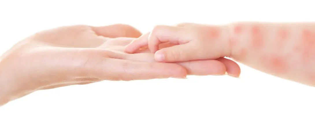 Vitamine D tegen eczeem