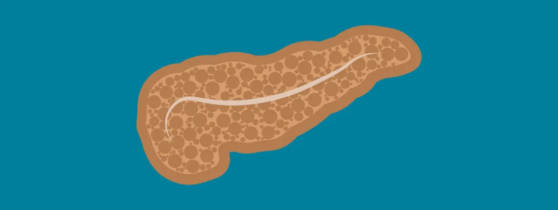 Overgewicht verergert pancreatitis