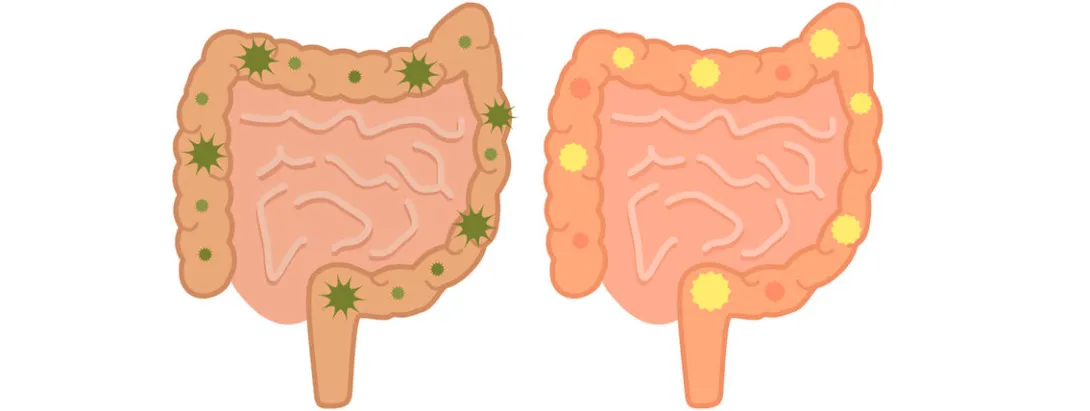 Minder antibiotica-geassocieerde diarree bij verpleeghuisbewoners met probiotica