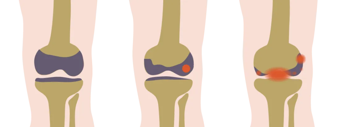 Leefstijlinterventie blijft helpen bij artrose